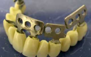 Когда пластиночные имплантаты ― единственно правильный выбор для замещения утерянных зубов