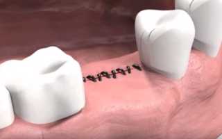 Провокаторы расхождения швов после имплантации зубов и как избежать последствий