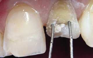 Парапульпарный штифт как один из способов восстановления сильно разрушенного зуба