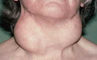 Способы лечения тиреоидита щитовидной железы