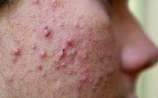 Заболевание золотистый стафилококк на коже
