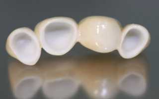 Керамическая коронка на зуб: описание видов, достоинства, цены и отзывы