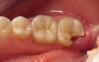 Что приводит к разрушению стенки зуба и в каких случаях выполняется ее удаление