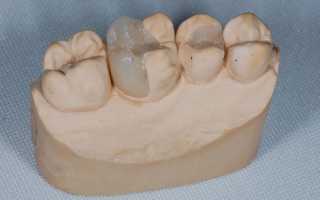 Вся правда о восстановлении функциональности зубного ряда с применением композитных вкладок