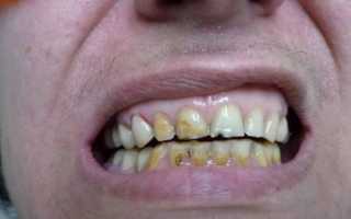 Причины возникновения кислотного некроза зубов и терапевтические меры