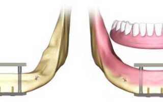 Восстановление жевательной функции с помощью чрезкостной имплантации