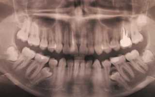 Импактный и ретинированный зуб — чем они отличаются друг от друга?