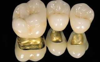 Какие коронки на зубы лучше подойдут в разных случаях?