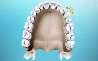 Эффективные тактики исправления транспозиции зуба