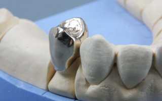 Стальные коронки на зубы — один из надежных вариантов восстановления