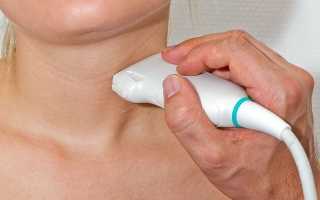 Как возникает карцинома щитовидной железы?