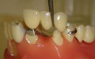 Когда составные мостовидные протезы – единственная возможность восполнить зубной ряд