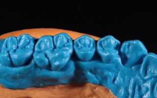 Восковое моделирование зубов как вариант планирования результата лечения
