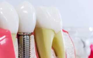 Гарантия на имплантацию зубов – требования и нюансы, хитрости и уловки