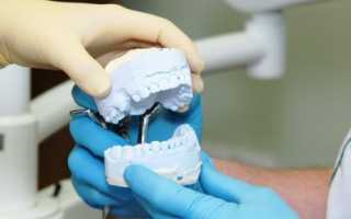 Сколько времени уходит у пациента на протезирование зубов