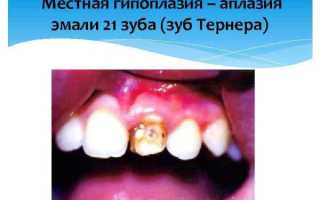 Зубы Тернера – дефект необратим, но не опасен