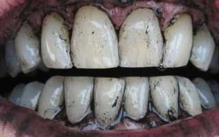 Как проводится отбеливание зубов активированным углем