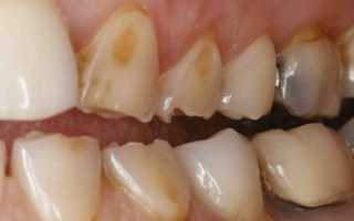 Чем опасна эрозия эмали зубов, и как с ней бороться?