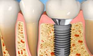 Как проходит приживление зубных имплантов, и в чем заключаются трудности процесса