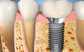 Как проходит приживление зубных имплантов, и в чем заключаются трудности процесса
