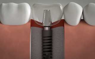 Применимо ли восполнение утраченных зубов у детей с помощью имплантации