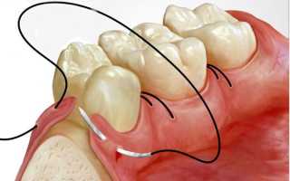 Разновидности современного стоматологического шовного материала