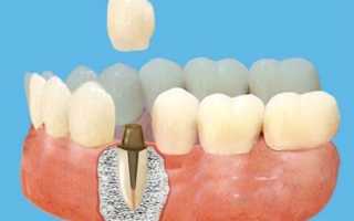 Металлическая вкладка – надежный шанс сохранения функциональности разрушенного зуба