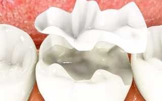 Тонкости реставрации жевательных зубов в зависимости от сложности случая