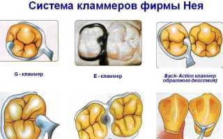 Виды и применение кламмеров системы Нея в стоматологической ортопедии