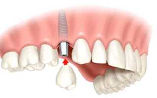 Виды и этапы одномоментной имплантации зубов