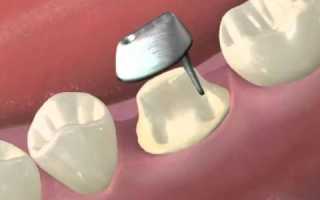 Нюансы восстановления зубов культевыми вкладками из кобальт-хромового сплава