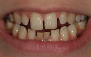Тремы между зубами: причины возникновения, виды, лечение
