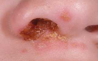 Заболевание стафилококк в носу у ребенка