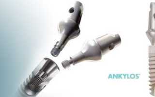 Имплантаты Ankylos (Анкилоз): достоинства, разновидности, цены