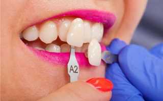 Положительные и отрицательные стороны исправления прикуса винирами в стоматологии