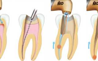 Как проводится чистка каналов зуба?