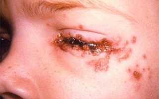 Хламидии в глазах: симптомы и лечение