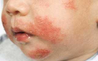 Какие кожные высыпания наблюдаются при лямблиозе у детей?
