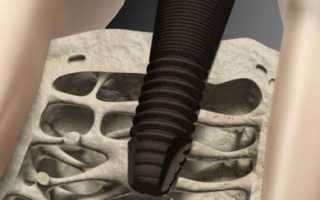 Подводные камни имплантации зубов при гепатите