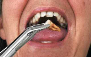 Когда нужно при установке брекетов удалять зубы?