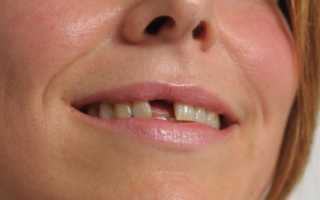 Протезирование зубов без обточки: виды, преимущества, цены