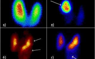 Радиоизотопное исследование щитовидной железы
