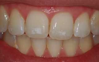 Боремся с белыми пятнами на зубах