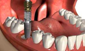 Почему могут выпадать импланты зубов, и как этого избежать?