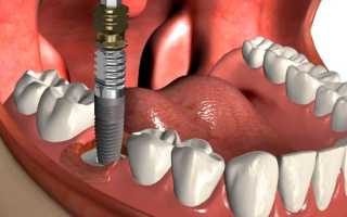 Почему могут выпадать импланты зубов, и как этого избежать?