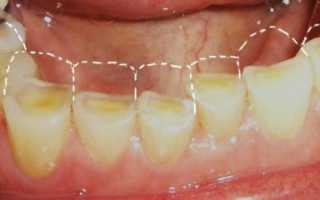 Какие факторы провоцируют стирание зубов и грамотный подход к устранению проблемы