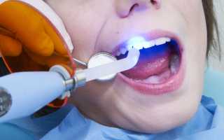 Световые пломбы на передних зубах: особенности, плюсы и минусы, стоимость